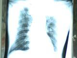 咳嗽可能是肺癌早期症状